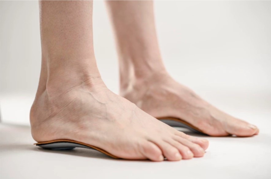 Kaki Datar (Pes Planus)